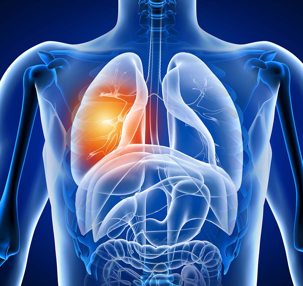 Χρόνια Αποφρακτική Πνευμονοπάθεια (ΧΑΠ) - Μπιώτη Γεωργία - Πνευμονολόγος - Φυματιολόγος